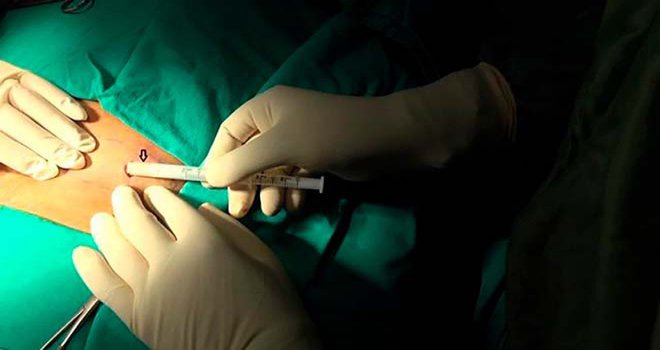 Bolu’da, madde bağımlıları deri altına koyulan çiple tedavi oluyor